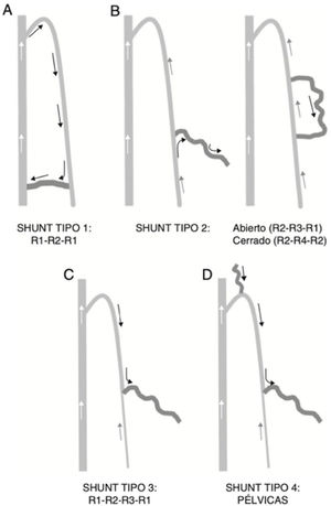 Tipos de shunts en función del punto de fuga y reentrada.