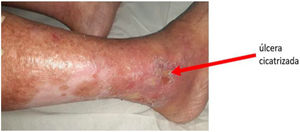 Úlcera venosa cicatrizada en paciente con insuficiencia venosa grado C5.