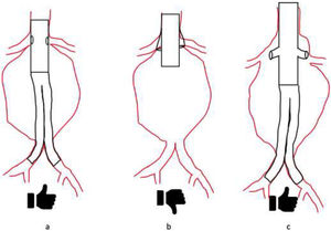 a) Endoprótesis aórtica fenestrada en aorta visceral de pequeño diámetro. b) Endoprótesis aórtica con ramas en aorta visceral de pequeño diámetro. c) Endoprótesis aórtica con ramas en aorta visceral de gran diámetro.