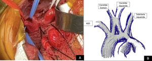 A) Imagen transquirúrgica de fusión superior de carótida común y carótida izquierda con nacimiento independiente de ostium. B) Esquema de hallazgo quirúrgico.