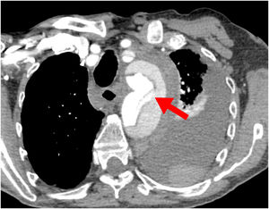 Disección aórtica aguda con rotura intimal localizada en el arco aórtico. Se observan, además, hemomediastino y hemotórax.