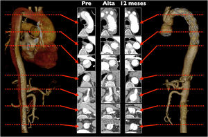 Evolución de la falsa luz en la aorta torácica descendente antes de la cirugía, al alta y a los 12meses.