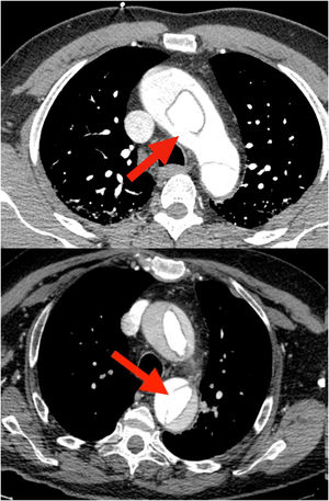 Disección aórtica aguda con rotura intimal localizada en A)arco aórtico y B)aorta torácica descendente proximal.