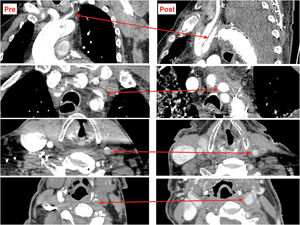 Disección aórtica aguda con malperfusión cerebral por oclusión de la arteria carótida común izquierda, antes y después de la FET.