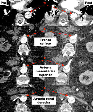 Disección aórtica aguda con malperfusión visceral por colapso de la luz verdadera en la aorta abdominal, antes y después de la FET.TL: luz verdadera.