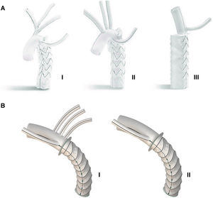 Prótesis híbridas comercializadas actualmente en Europa. A)Prótesis Thoraflex. B)Prótesis E-Vita Open Plus.