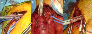 Estrategia de canulación arterial: A)Arteria axilar derecha. B)Tronco braquiocefálico. C)Arteria carótida común derecha.