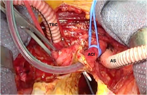 Perfusión cerebral total mediante perfusión del tronco braquiocefálico (TBC), arteria carótida común izquierda (ACI) y arteria subclavia izquierda (AS).