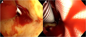 Angioscopia de la aorta descendente bajo parada circulatoria. A)Catéter pigtail colocado en la luz verdadera. B)Prótesis híbrida en la luz verdadera de la aorta descendente proximal correctamente expandida.