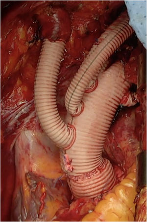 Resultado final tras el implante de la prótesis E-Vita Open Neo trifurcada.