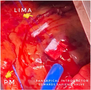 LIMA: arteria mamaria interna izquierda anastomosada a arteria descendente anterior+introductor para implante transapical de TAVI. PM: MP epicárdico temporal.