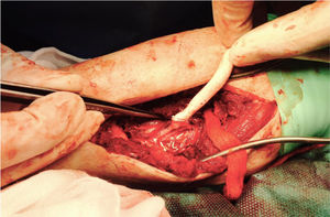 Detalle de un cuff de Miller en un bypass femoral común/peronea por vía lateral con PTFE.