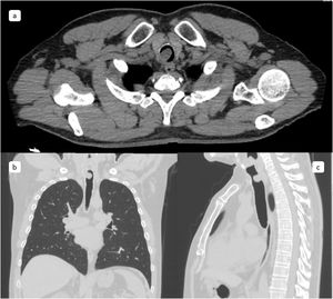 Tomografía de cuello y tórax: a) corte axial, b) corte coronal y c) corte sagital. El tumor protruye de la pared posterior y lateral derecha de la tráquea, pediculada de 12 x 15mm de diámetro que se proyecta hacia la luz traqueal que mide 12,5 x 22 x 15mm, coeficiente de atenuación– 26 y 17 UH, que condiciona estenosis de luz traqueal del 90%, sin compromiso esofágico y sin evidencia de adenopatías locorregionales.