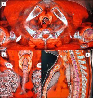 Tomografía de cuello y tórax reconstrucción 3D: a) corte axial b) corte coronal y c) corte sagital. Tumor traqueal que protruye de la pared posterior y lateral derecha, pediculada que condiciona estenosis de luz traqueal del 90%, sin compromiso esofágico.