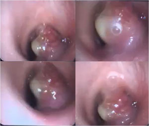 Broncoscopia flexible diagnóstica: se evidenció una masa vegetante infiltrativa que se origina en porción posterior de la tráquea por debajo de primer anillo traqueal, vascularizada con membranas blanquecinas adheridas, que condiciona una obstrucción del 90% de la luz traqueal.