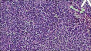 Estudio histopatológico: tinción HE 40 X. Tumor de células redondas pequeñas y azules se realiza pruebas de inmunohistoquímica vimentina, actina, CK, AE1/AE3 y sinaptoficina positivos, KI 5%, bordes libres, negativo para malignidad concluyendo que se trata de un tumor glómico. El color de la figura solo puede apreciarse en la versión electrónica del artículo.