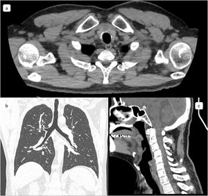 Tomografía de cuello y tórax de control: a) corte axial, b) corte coronal y c) corte sagital. Luz traqueal permeable sin recidiva tumoral.