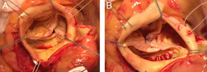 A)Válvula aórtica bicúspide, configuraciónB, con comisura no funcional entre velo coronariano derecho y no-coronariano. B)Válvula aórtica bicúspide reparada con implante de anillo Haart 200, 25mm más sutura de rafe.