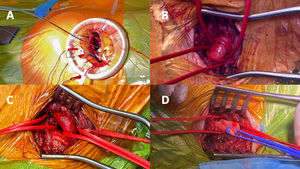 Imágenes quirúrgicas de los accesos transapical (A), arteria carótida común (B), arteria axilar izquierda (C) y tronco braquiocefálico (D).