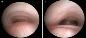 Imágenes de fibrobroncoscopia dinámica. A) Compresión traqueal > 50%. B) Carina traqueal no colapsada. Imágenes cedidas por el Dr. García Torres.