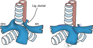 Ilustración de sling de la arteria pulmonar, a la izquierda. A la derecha, resultado tras reparación quirúrgica. Lig.: ligamento; RPD: rama pulmonar derecha; RPI: rama pulmonar izquierda. Ilustraciones cedidas por el Dr. García Torres.