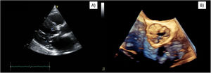 Preoperative transthoracic echocardiogram. (A) Long axis parasternal view showing LV hypertrophy and a small LV cavity. (B) 3D aortic valve reconstruction revealing severe stenosis. LV=left ventricle.