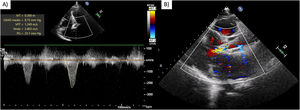 Immediate post-TAVI transthoracic echocardiogram. Continuous wave Doppler showing (A) intraventricular gradient of 23mmHg and maximum velocity of 2.4m/s, no SAM of the mitral valve was documented, (B) LV mid-cavitary gradient. LV=left ventricle, TAVI=transcatheter aortic valve implantation, SAM=systolic anterior motion.