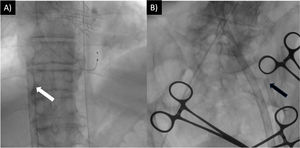 Percutaneous ECMO cannulation with ultrasound-guided puncture and fluoroscopic guidance, following trans aortic valve implantation. (A) White arrow indicates the left femoral extraction venous cannula placed at the Cavo atrial junction. (B) Black arrow indicates the return cannula placed in the left superficial femoral artery. The right femoral artery was used for valve implantation and balloon valvuloplasty. ECMO=extracorporeal membrane oxygenation.