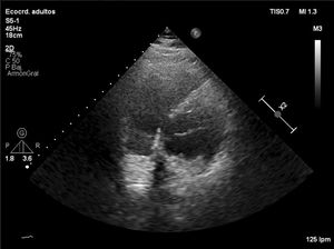 Ecocardiograma transtorácico de urgencias sin visualizar la pared inferolateral del ventrículo izquierdo.