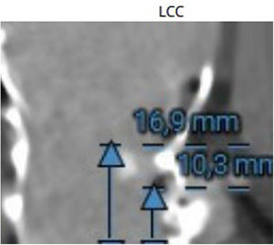 Altura de las coronarias al plano valvular de la TAVI.