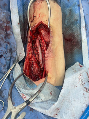 Bovine pericardium tube graft used to reconstruct infected Dacron graft in left popliteal artery.