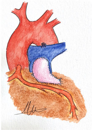 Arteriotomía pulmonar transanular extendida de forma paralela a la arteria coronaria anómala.