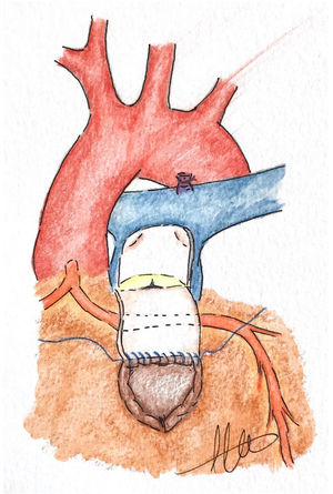 Técnica de van Son. Colgajo en forma de U invertida, girado hacia atrás pasando por encima de la arteria coronaria anómala, como un puente sobre la coronaria, y suturado al extremo superior de la ventriculotomía.