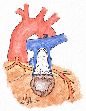 Translocación del tronco arterial pulmonar.