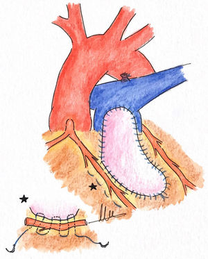 Implante de parche de pericardio para la ampliación del tracto de salida del ventrículo derecho, donde una parte de la línea de sutura es subcoronaria, aquella más próxima a la arteria coronaria anómala. Se trata de una línea de sutura continua con puntos en U, comenzando en el parche de pericardio, pasando por debajo la arteria coronaria y saliendo lateral a ella en el epicardio. Después la sutura regresa desde el epicardio al endocardio bajo la arteria coronaria, llegando al parche de pericardio, manteniendo así la arteria coronaria como en una isla de miocardio.