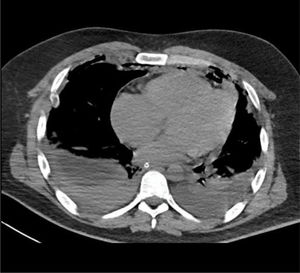 TAC de tórax con infiltración de grasa mediastínica y derrame pleural bilateral.