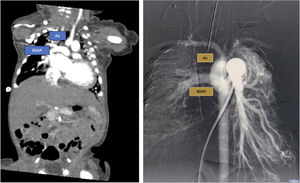 A) Tomografía cardiaca donde se observa nacimiento de la rama derecha de la arteria pulmonar de la porción posterior de la aorta ascendente. B) Cateterismo cardiaco en el cual se observa a través del conducto arterioso se llena la aorta de forma retrógrada, observándose tardíamente llenado de la rama derecha.