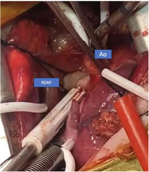 Imagen transquirúrgica donde se observa nacimiento anómalo de la rama derecha de la aorta ascendente.