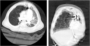 Detail of the CT scan, where congenital lobar emphysema is observed by moving the electrode.