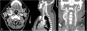 A-C) Tomografía computarizada que evidencia tumor del glomus carotídeo clasificación Shamblin III.