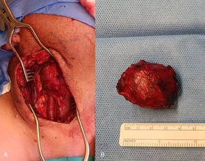 A) Cirugía de resección de tumor del glomus carotídeo Shamblin III. B) Tumor del glomus carotídeo de aproximadamente 4cm×3cm×2cm.