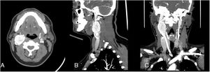 A-C) Tomografía computarizada que evidencia tumor del glomus carotídeo clasificación Shamblin II.