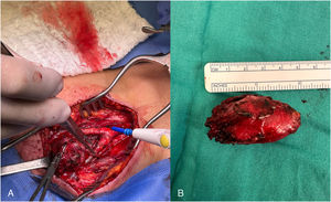 A) Cirugía de resección de tumor del glomus carotídeo Shamblin II. B) Tumor del glomus carotídeo de aproximadamente 5cm×3cm×2cm.