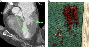 Miectomía septal extendida. A)Identificación y medición de la hipertrofia mediante TC cardíaca. B)Comprobación intraoperatoria de la exéresis completa de la hipertrofia muscular evidenciada en el estudio preoperatorio.