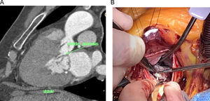 A)Identificación por TC cardíaca de cuerdas anómalas, indicadas con la flecha verde. B)Resección con corte frío.