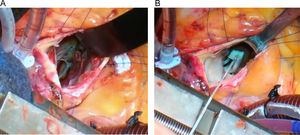 Reagrupamiento de las cabezas de los músculos papilares (A), con sutura no reabsorbible de PTFE 4/0 apoyada en pledgets para conseguir el realineamiento hacia posterior de la coaptación mitral (B).