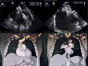 A) Dilatación del ventrículo derecho. B) Trombo de la aurícula derecha a izquierda. C) Tronco de la arteria pulmonar dilatada. D) Trombos en ambas principales y lobar de la arteria pulmonar.