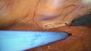 Disección endoscópica de la AMI.