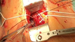 Anastomosis de la AMI-DA a corazón latiendo con estabilizador de coronarias por minitoracotomía.