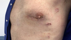 Resultado del cierre de la herida quirúrgica.